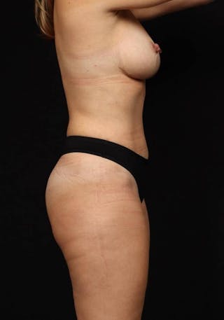 Mommy Makeover Before & After Gallery - Patient 259374 - Image 10