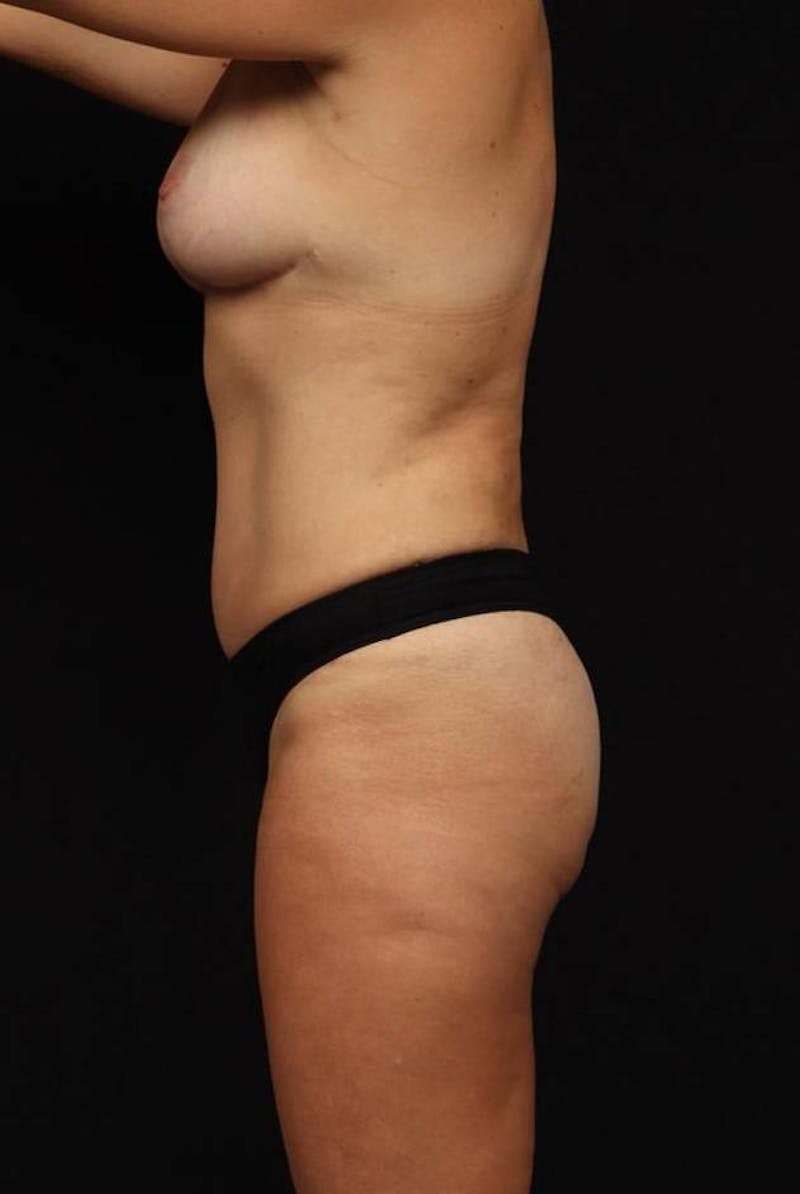 Mommy Makeover Before & After Gallery - Patient 401685 - Image 6