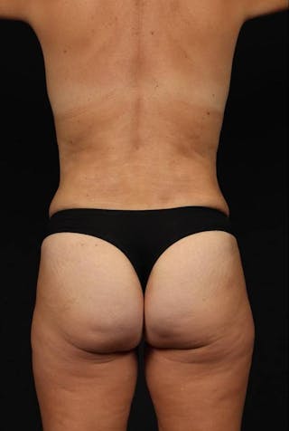 Mommy Makeover Before & After Gallery - Patient 401685 - Image 12