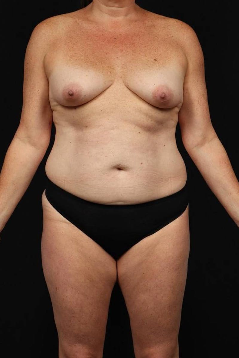 Mommy Makeover Before & After Gallery - Patient 431996 - Image 1