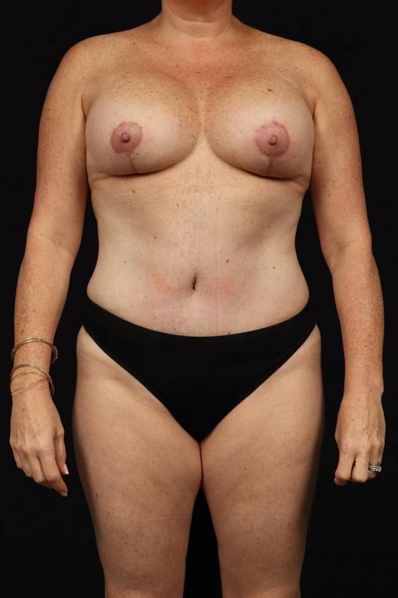 Mommy Makeover Before & After Gallery - Patient 431996 - Image 2