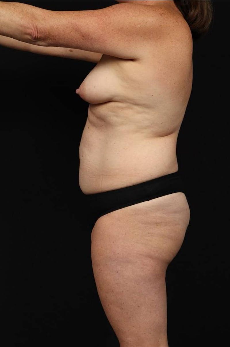 Mommy Makeover Before & After Gallery - Patient 431996 - Image 5