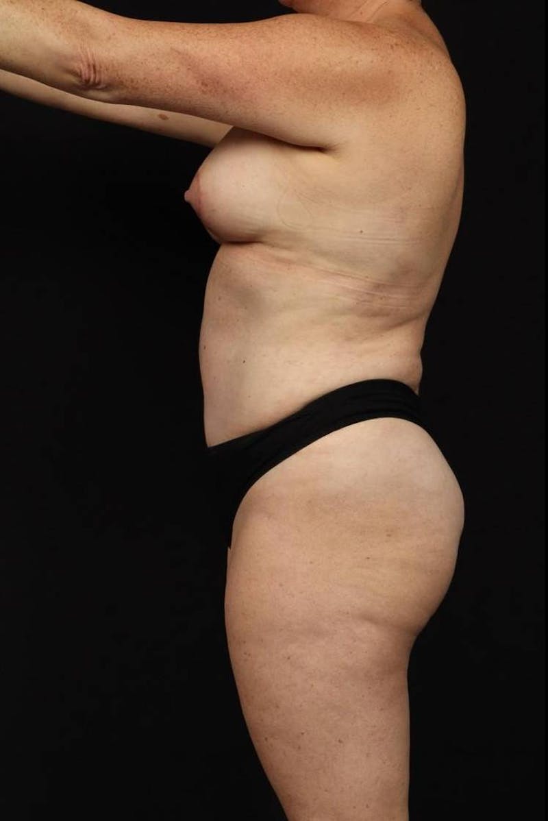 Mommy Makeover Before & After Gallery - Patient 431996 - Image 6