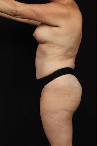 Mommy Makeover Before & After Gallery - Patient 431996 - Image 6