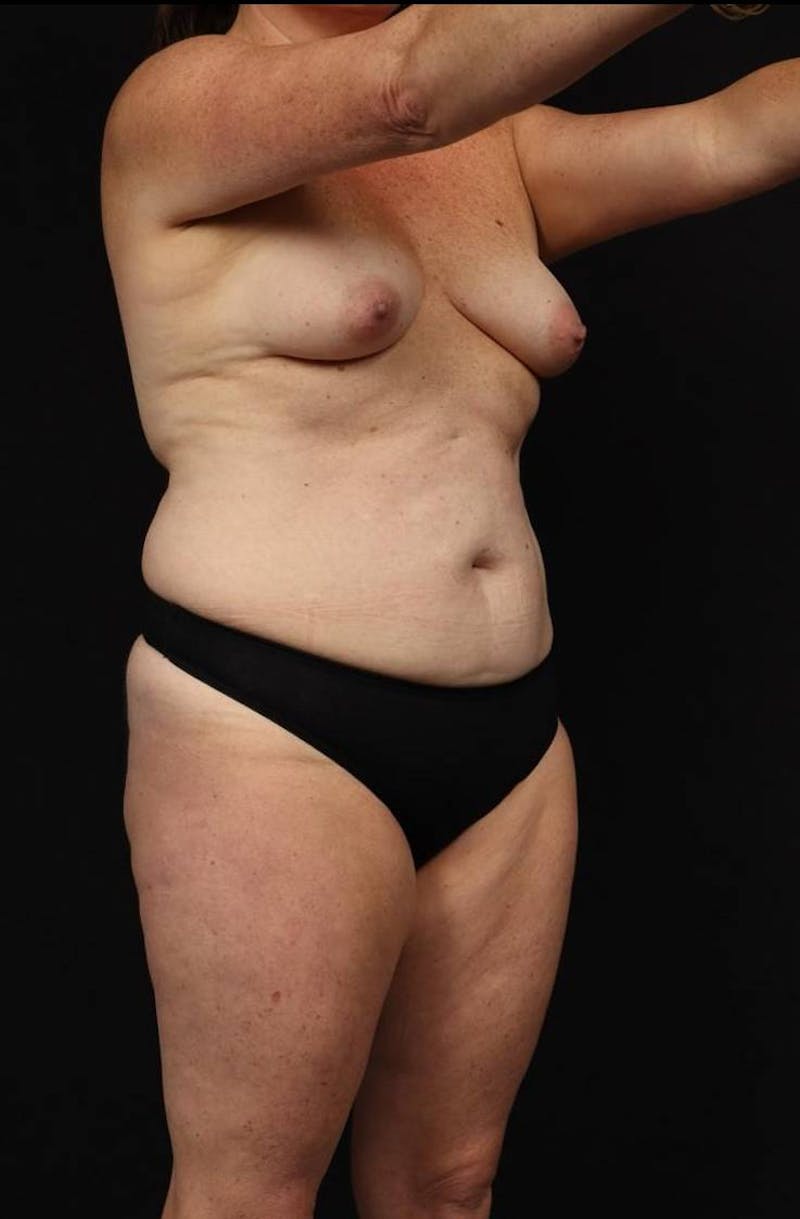 Mommy Makeover Before & After Gallery - Patient 431996 - Image 7
