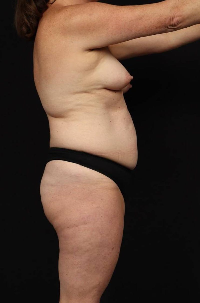 Mommy Makeover Before & After Gallery - Patient 431996 - Image 9
