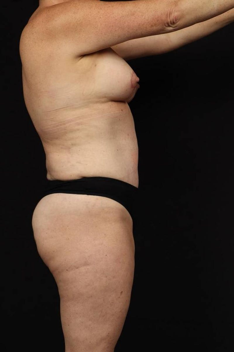 Mommy Makeover Before & After Gallery - Patient 431996 - Image 10