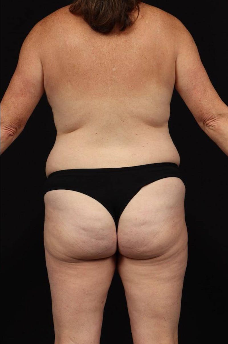 Mommy Makeover Before & After Gallery - Patient 431996 - Image 11