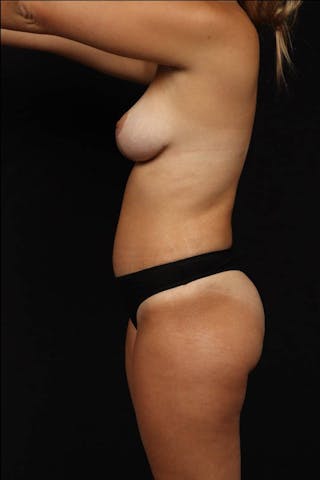 Mommy Makeover Before & After Gallery - Patient 189106 - Image 6