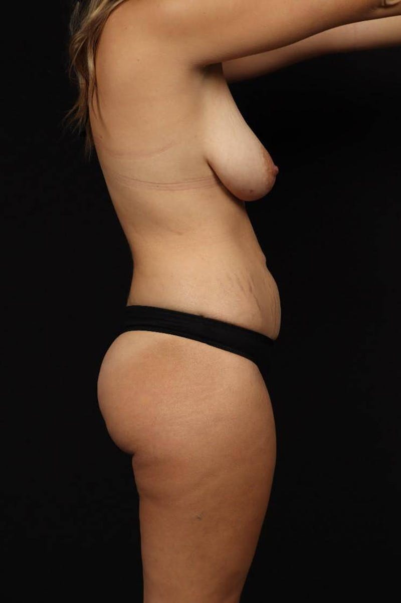 Mommy Makeover Before & After Gallery - Patient 189106 - Image 9