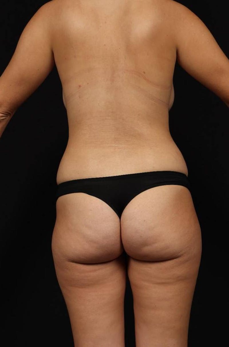 Mommy Makeover Before & After Gallery - Patient 189106 - Image 11