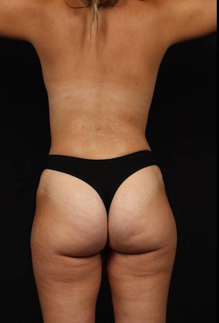 Mommy Makeover Before & After Gallery - Patient 189106 - Image 12