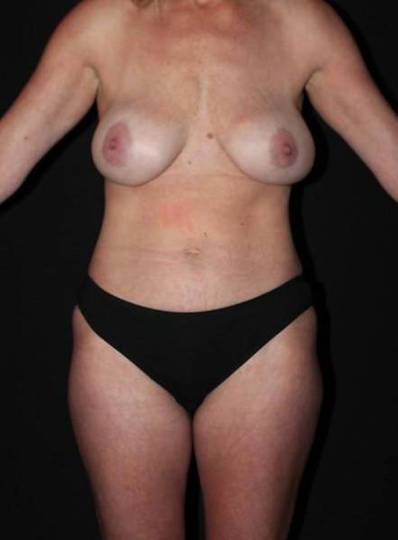 Mommy Makeover Before & After Gallery - Patient 287492 - Image 1