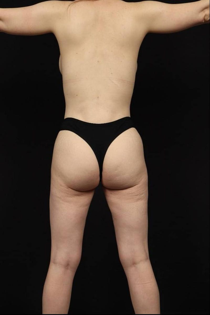 Mommy Makeover Before & After Gallery - Patient 867229 - Image 12