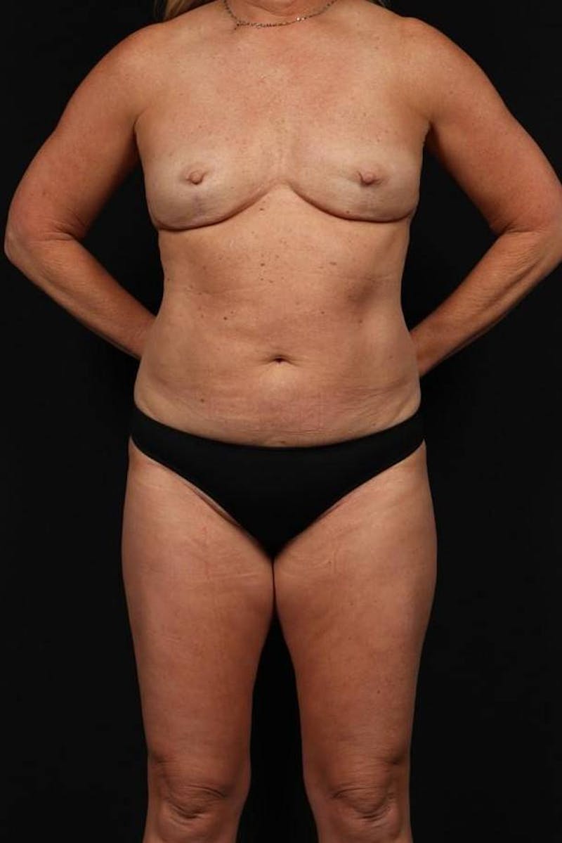 Mommy Makeover Before & After Gallery - Patient 590180 - Image 1