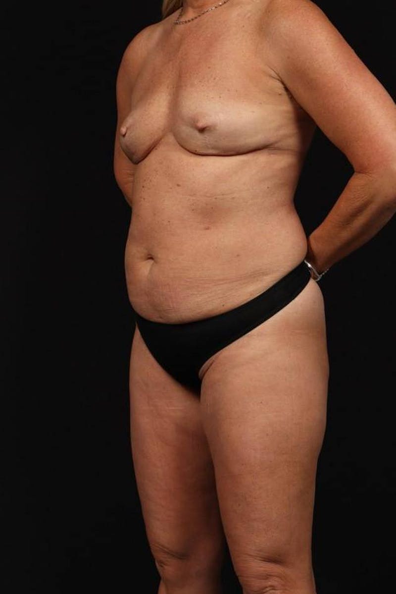 Mommy Makeover Before & After Gallery - Patient 590180 - Image 3