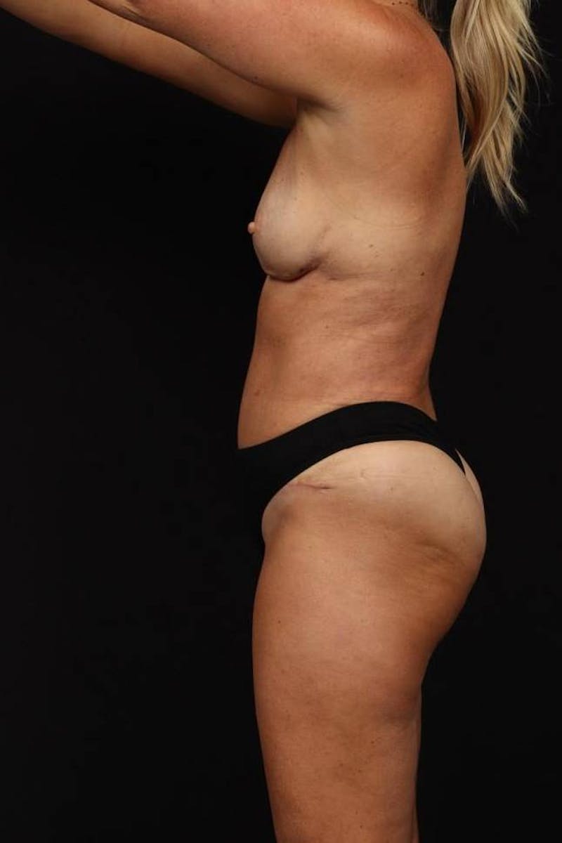 Mommy Makeover Before & After Gallery - Patient 590180 - Image 6