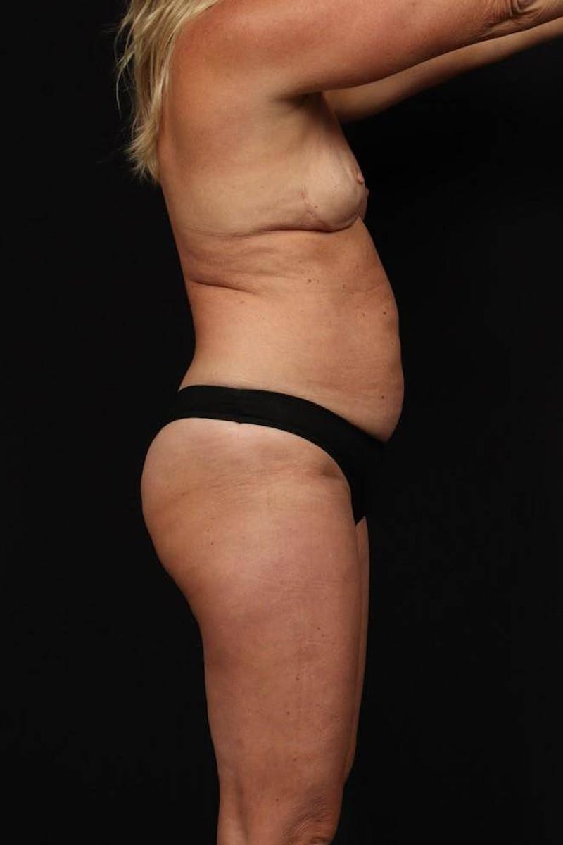 Mommy Makeover Before & After Gallery - Patient 590180 - Image 9