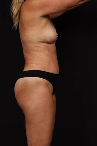 Mommy Makeover Before & After Gallery - Patient 590180 - Image 10