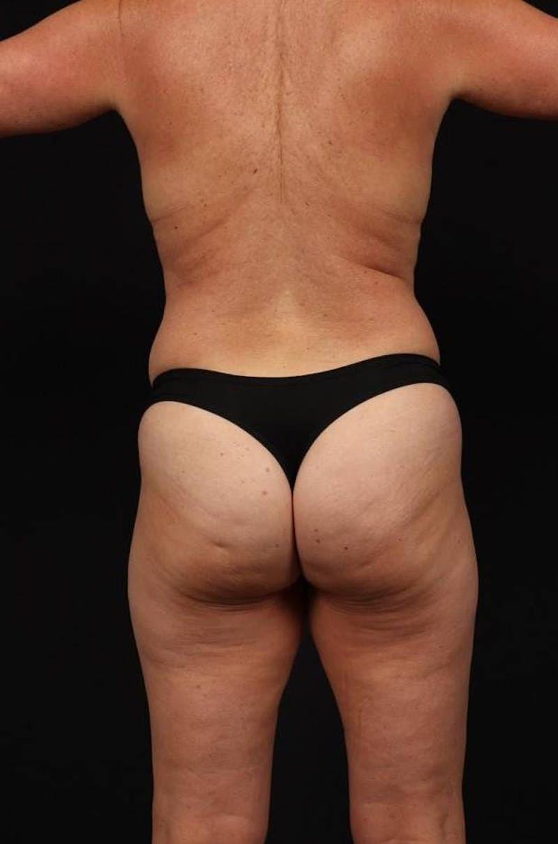 Mommy Makeover Before & After Gallery - Patient 590180 - Image 11