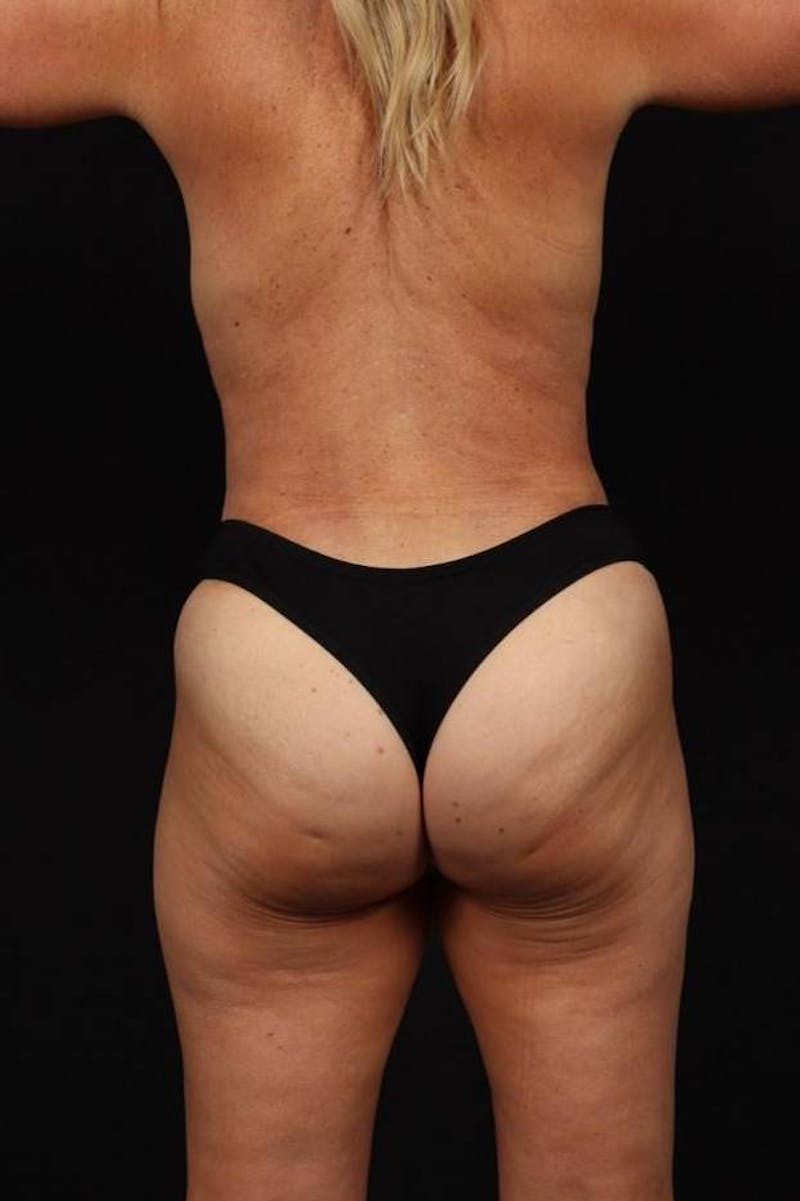 Mommy Makeover Before & After Gallery - Patient 590180 - Image 12