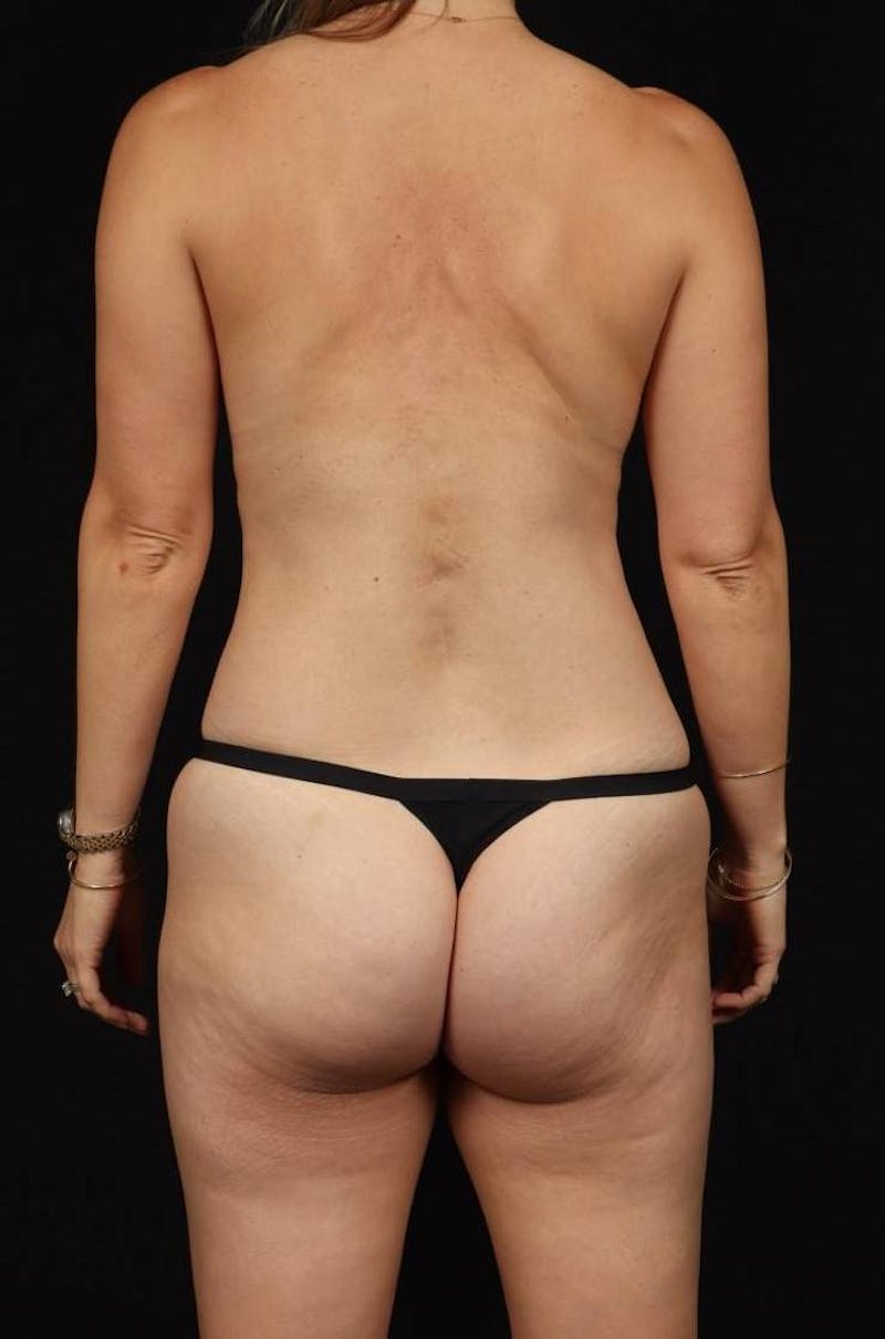 Mommy Makeover Before & After Gallery - Patient 406458 - Image 11