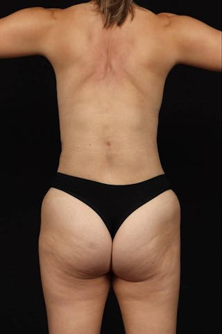 Mommy Makeover Before & After Gallery - Patient 406458 - Image 12