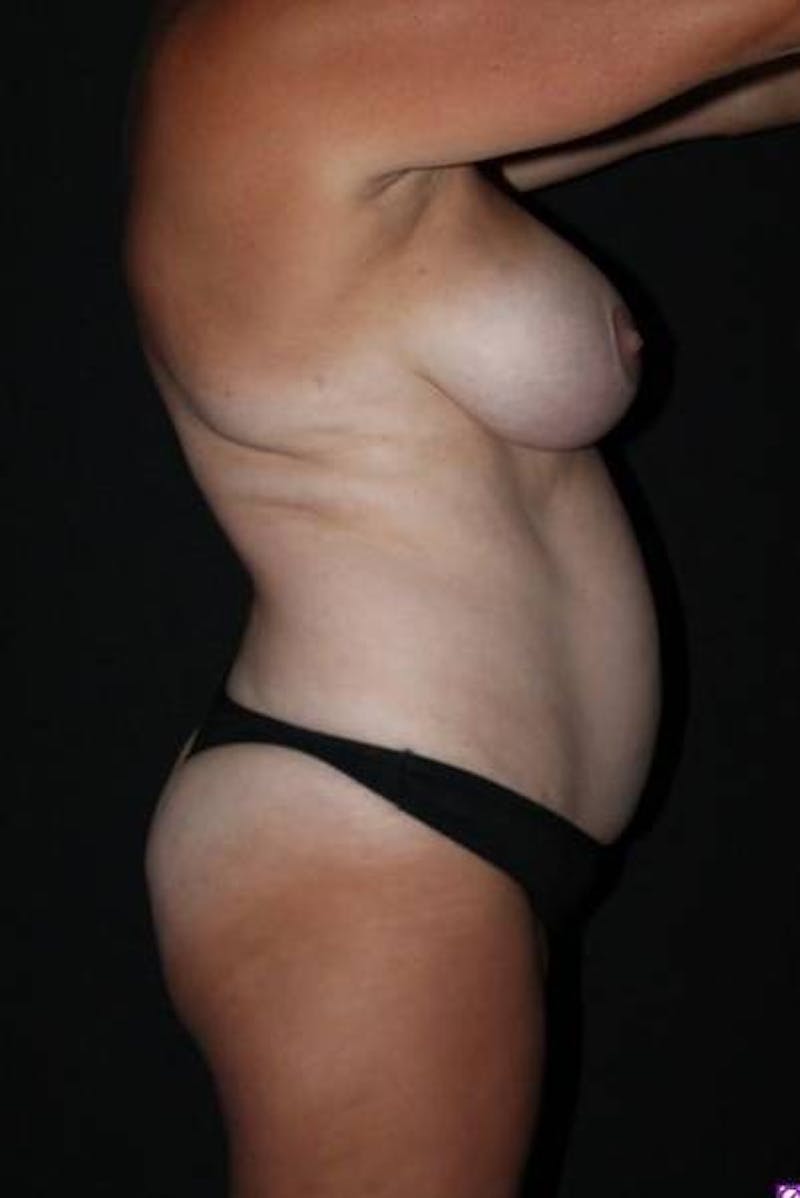 Mommy Makeover Before & After Gallery - Patient 414818 - Image 9