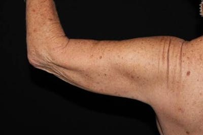 Arm Lift (Brachioplasty) Before & After Gallery - Patient 126242 - Image 1