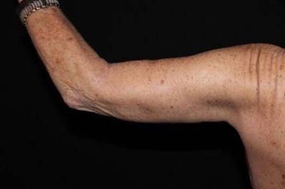 Arm Lift (Brachioplasty) Before & After Gallery - Patient 126242 - Image 2