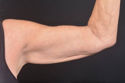 Arm Lift (Brachioplasty) Before & After Gallery - Patient 330764 - Image 1