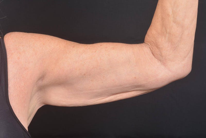 Arm Lift (Brachioplasty) Before & After Gallery - Patient 330764 - Image 1