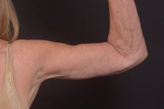 Arm Lift (Brachioplasty) Before & After Gallery - Patient 330764 - Image 2
