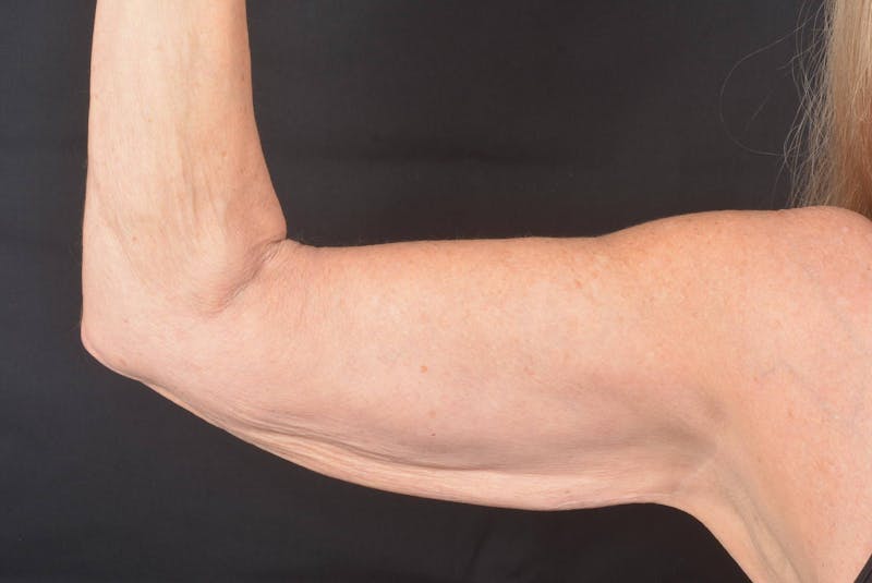 Arm Lift (Brachioplasty) Before & After Gallery - Patient 330764 - Image 3