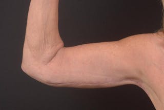 Arm Lift (Brachioplasty) Before & After Gallery - Patient 330764 - Image 4