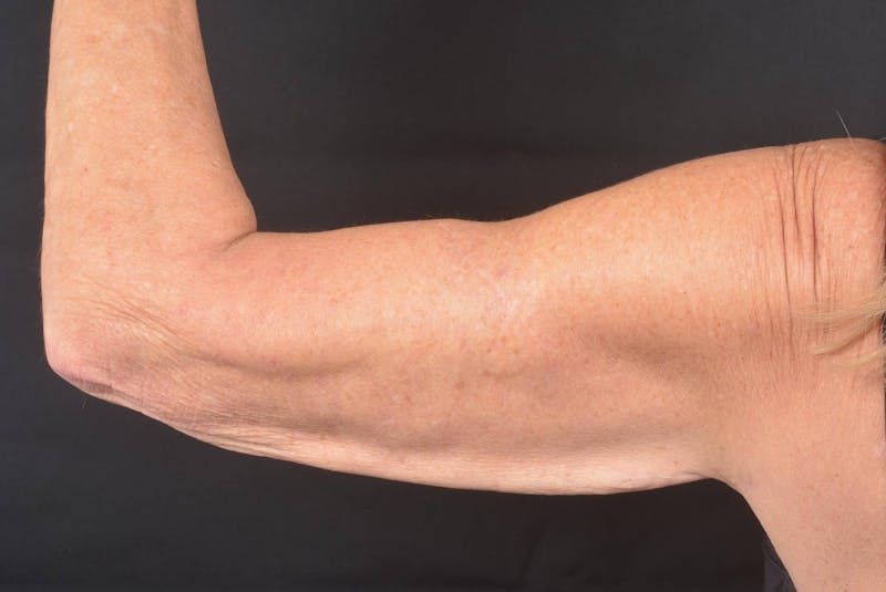 Arm Lift (Brachioplasty) Before & After Gallery - Patient 330764 - Image 5