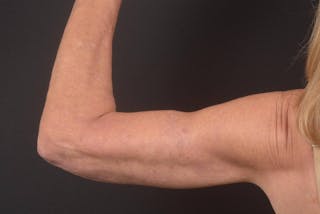 Arm Lift (Brachioplasty) Before & After Gallery - Patient 330764 - Image 6