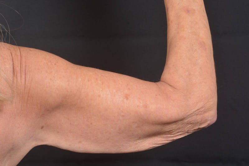 Arm Lift (Brachioplasty) Before & After Gallery - Patient 330764 - Image 7