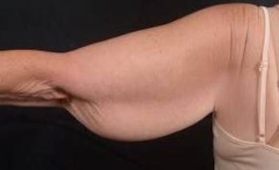 Arm Lift (Brachioplasty) Before & After Gallery - Patient 104170 - Image 1
