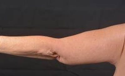 Arm Lift (Brachioplasty) Before & After Gallery - Patient 104170 - Image 2