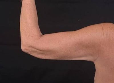 Arm Lift (Brachioplasty) Before & After Gallery - Patient 337372 - Image 1
