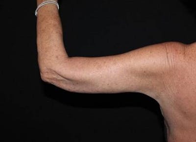 Arm Lift (Brachioplasty) Before & After Gallery - Patient 337372 - Image 2