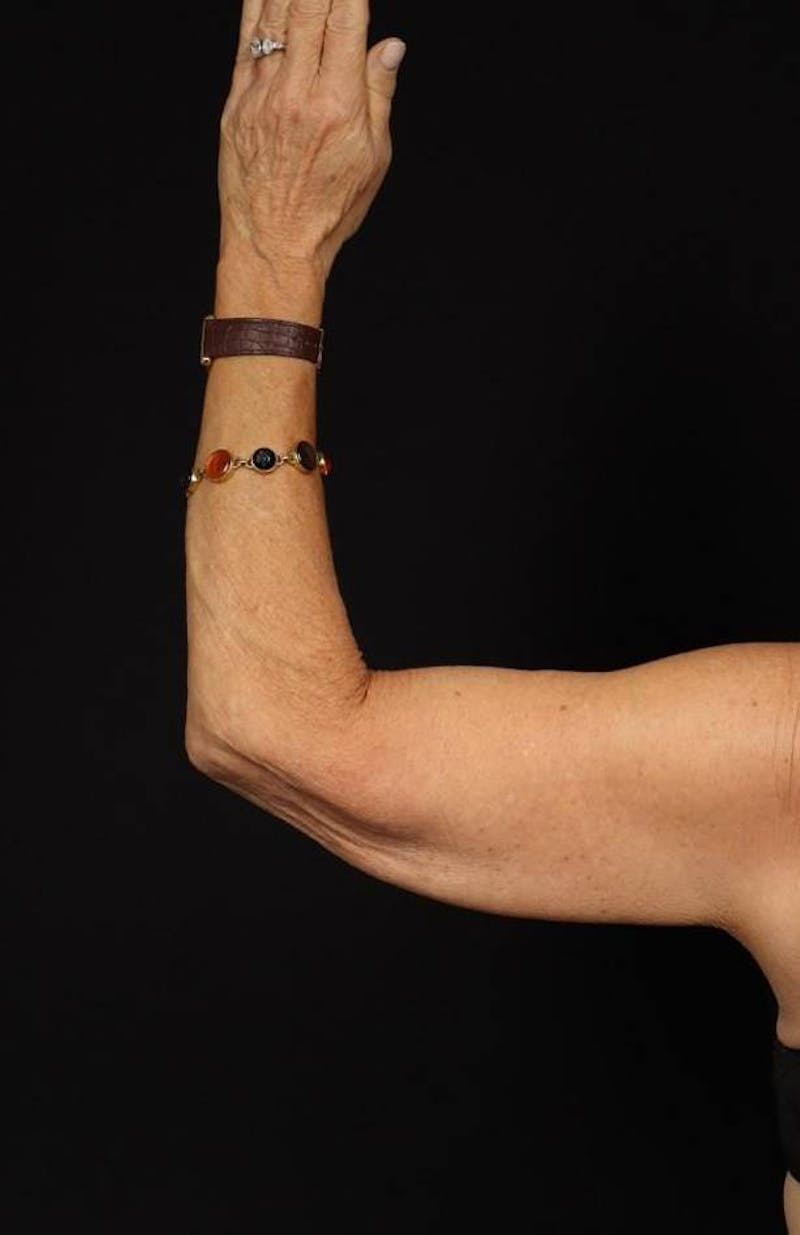 Arm Lift (Brachioplasty) Before & After Gallery - Patient 140345 - Image 1