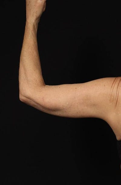 Arm Lift (Brachioplasty) Before & After Gallery - Patient 140345 - Image 2