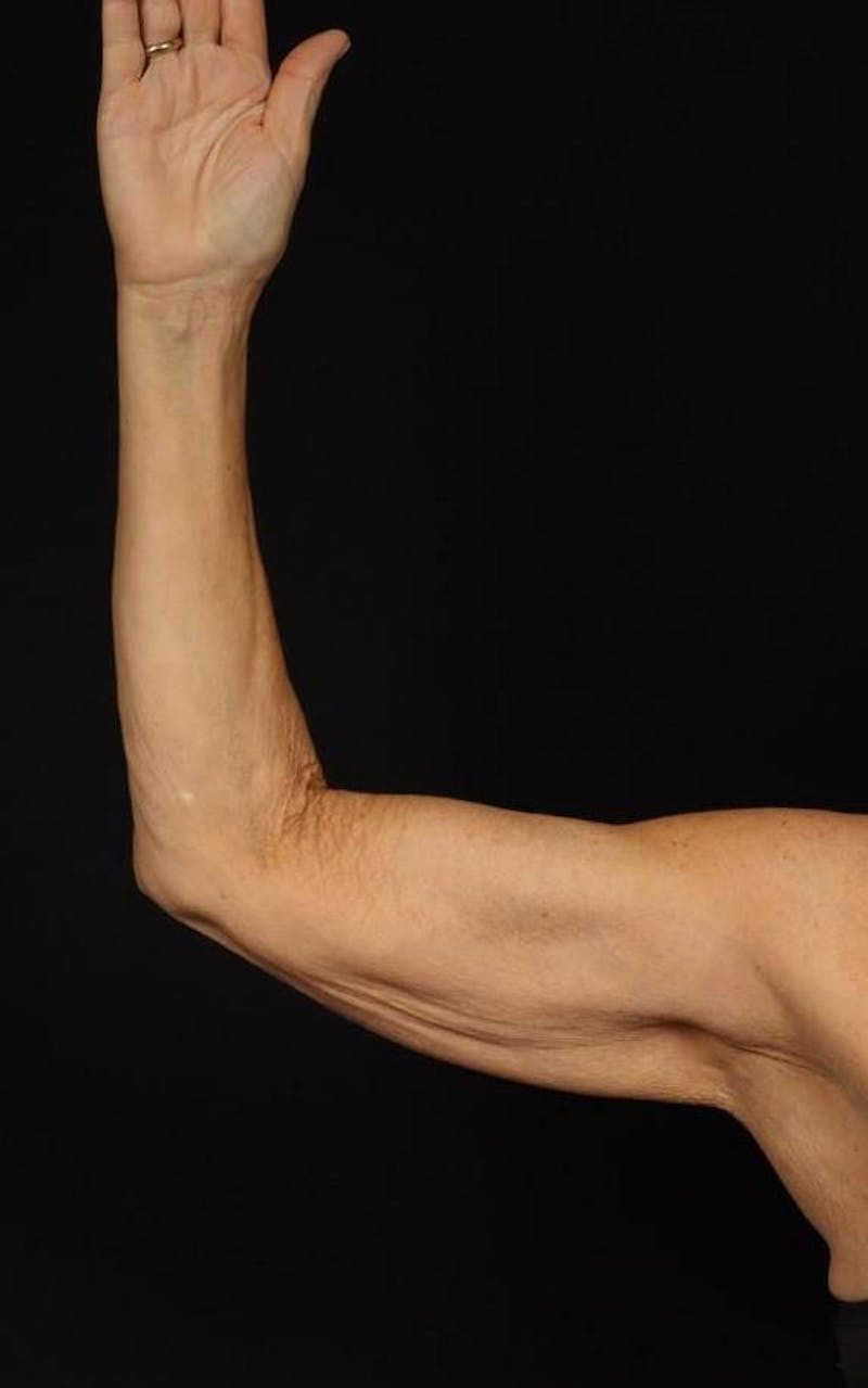 Arm Lift (Brachioplasty) Before & After Gallery - Patient 140345 - Image 3