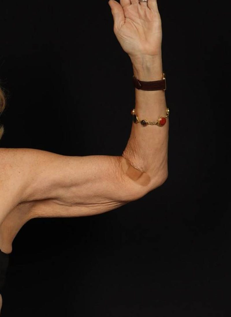 Arm Lift (Brachioplasty) Before & After Gallery - Patient 140345 - Image 5