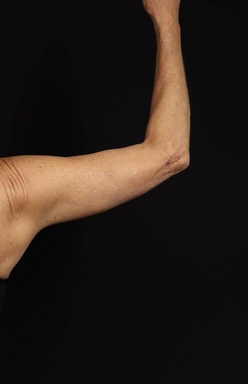 Arm Lift (Brachioplasty) Before & After Gallery - Patient 140345 - Image 8
