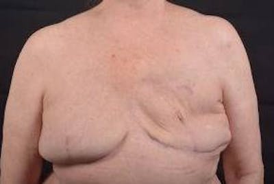 Delayed Breast Reconstruction Before & After Gallery - Patient 108170 - Image 1