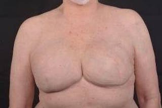 Delayed Breast Reconstruction Before & After Gallery - Patient 108170 - Image 2
