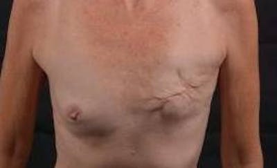 Delayed Breast Reconstruction Before & After Gallery - Patient 320892 - Image 1